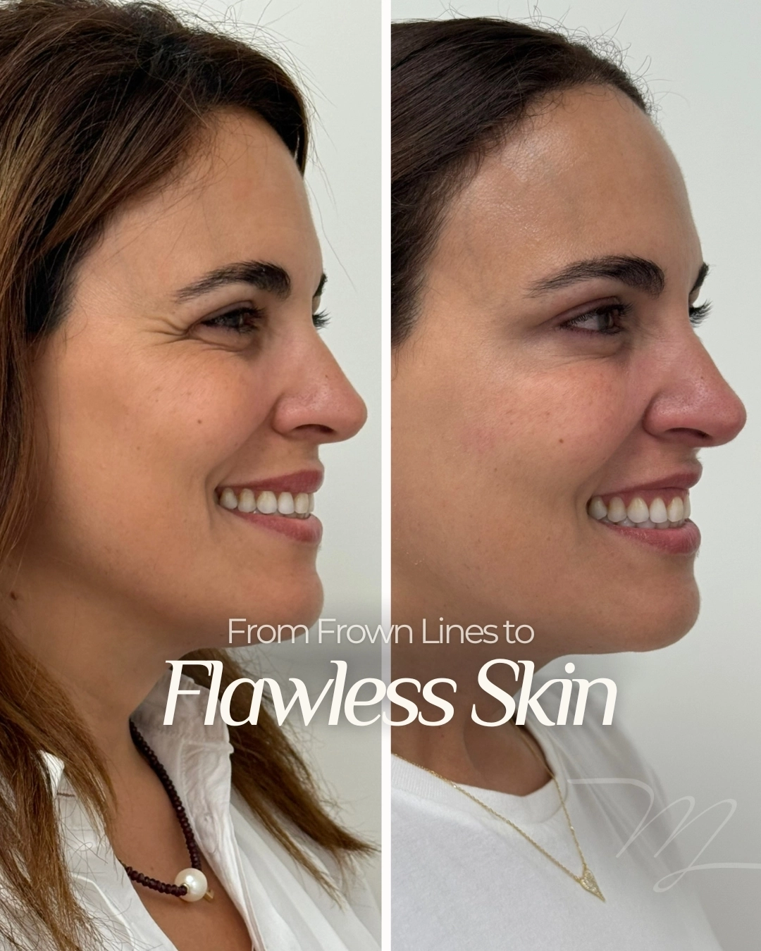 Botox in Miami Lakes, FL