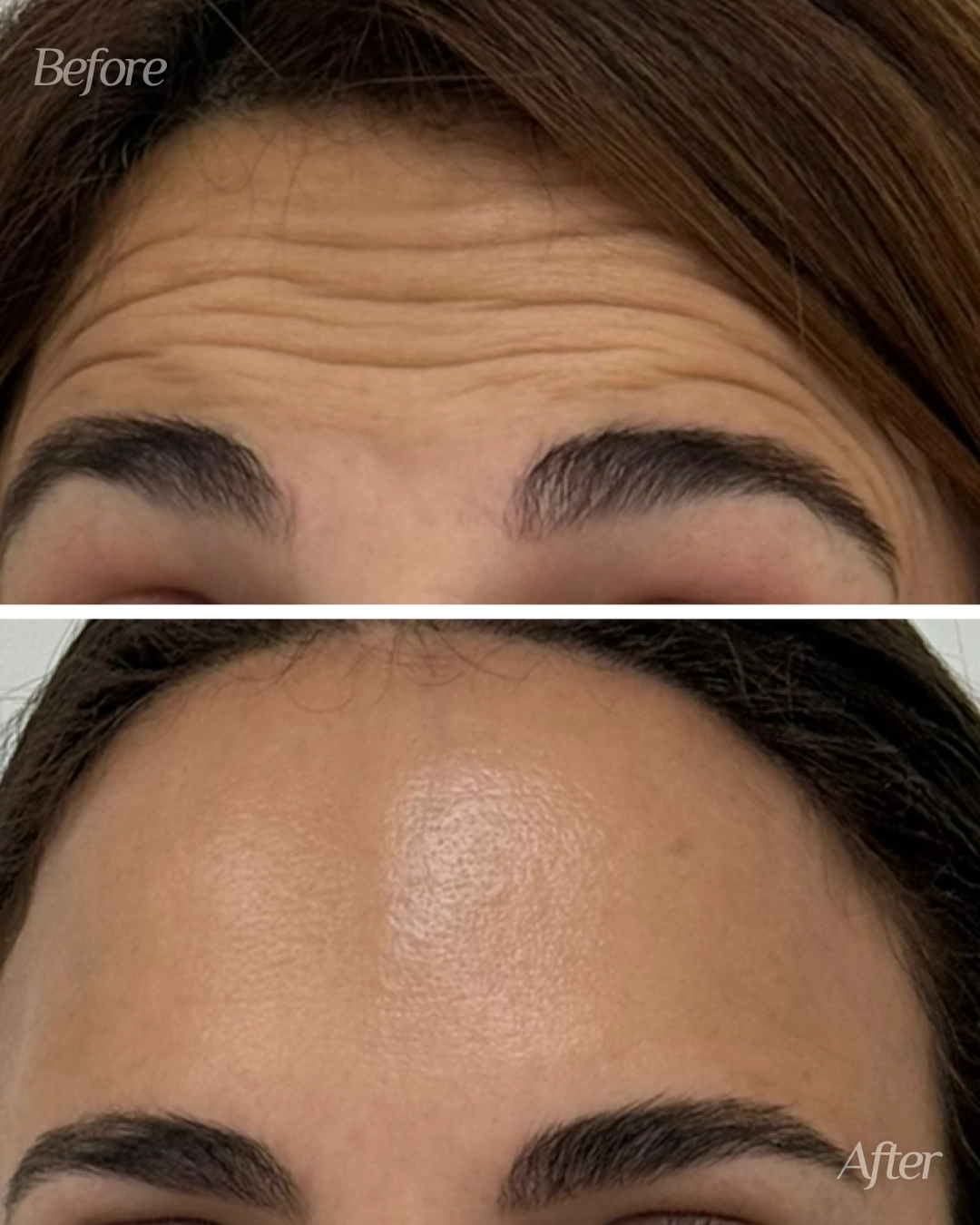 Botox in Miami Lakes, FL