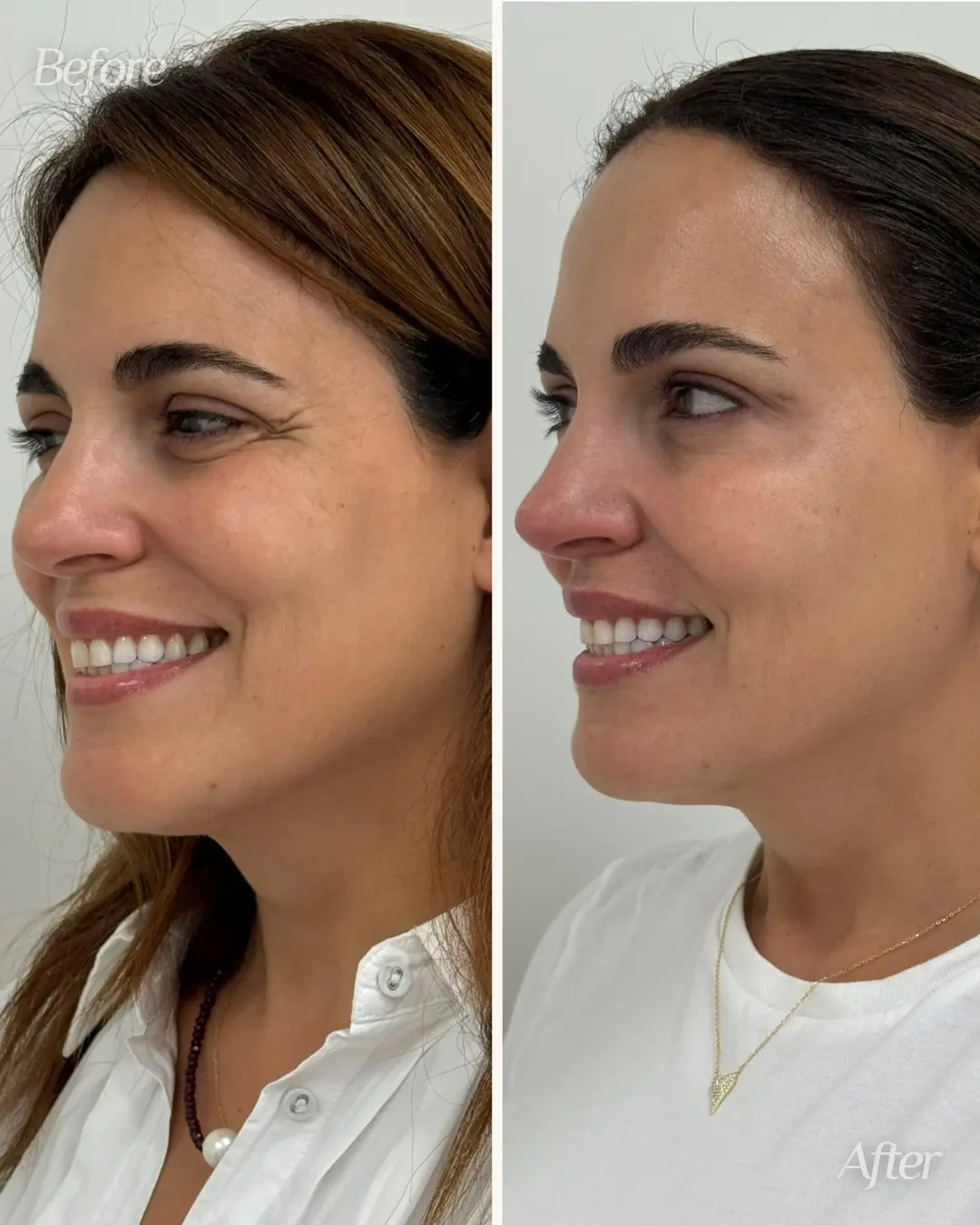 Botox in Miami Lakes, FL