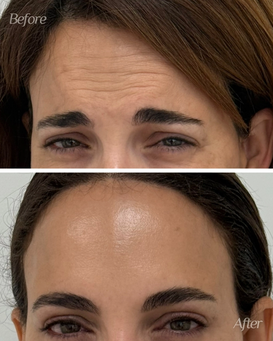 Botox in Miami Lakes, FL